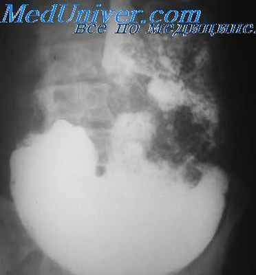 язвы желудка