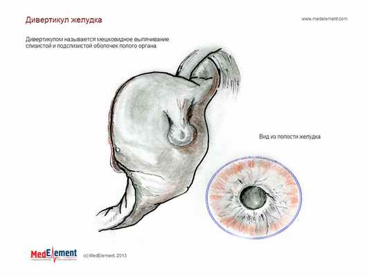 Дивертикул желудка