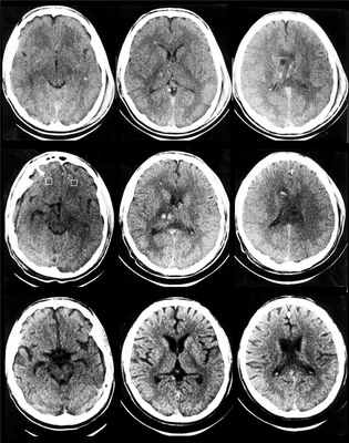 Диффузное аксональное повреждение головного мозга (вопросы визуализации)