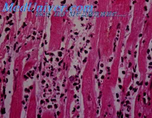 кардиосклероз при пороках фалло