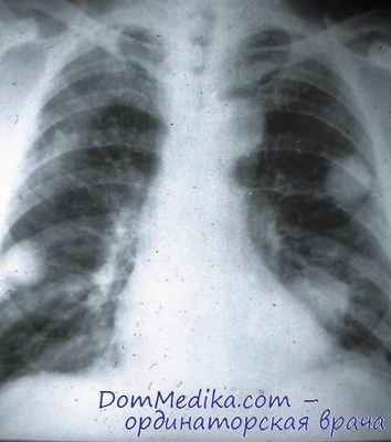 диффузное альвеолярное кровотечение