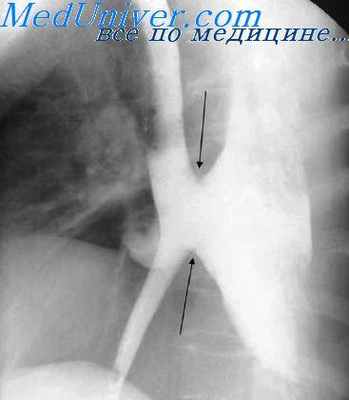 сокращение пищевода