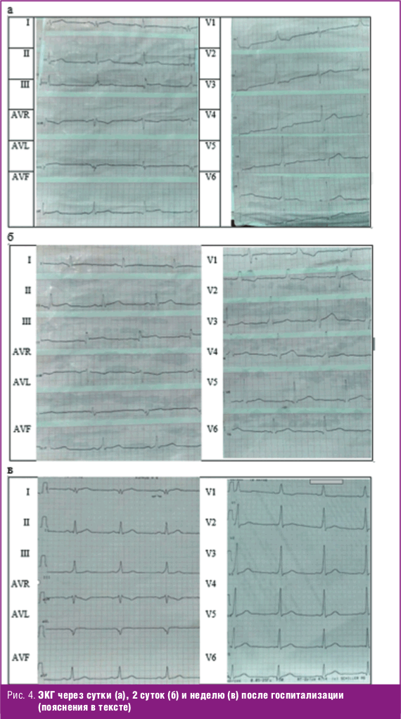 ЭКГ через сутки
