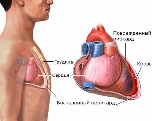 Синдром Дресслера - аутоиммунный процесс в перикарде и суставах