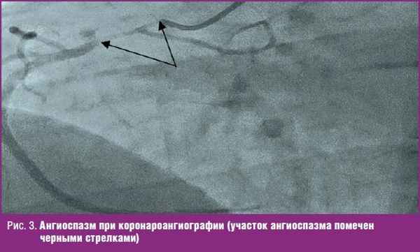Ангиоспазм при коронароангиографии
