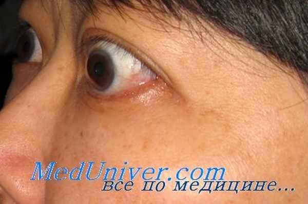 эндокринная офтальмопатия