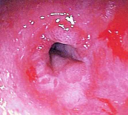 Пептическая стриктура пищевода в области нижнего пищеводного сфинктера