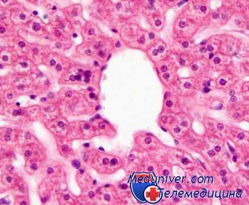 опухоль эндодермального синуса