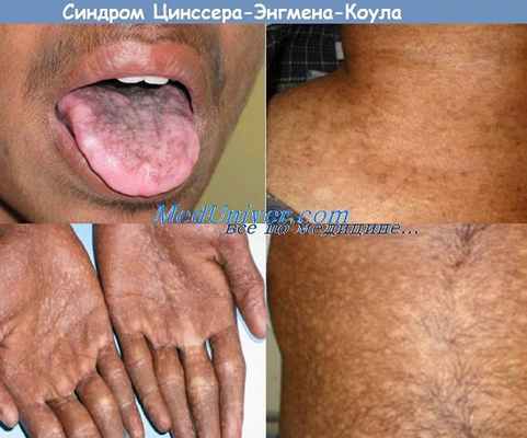синдром Цинссера-Энгмена-Коула