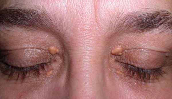 Ксантелазмы век