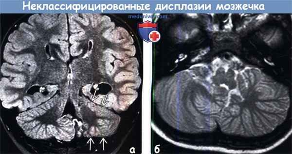 Дисплазия мозжечка на МРТ