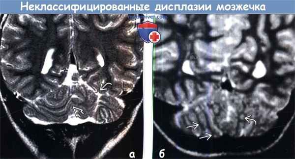 Дисплазия мозжечка на МРТ