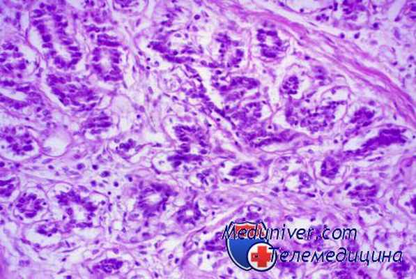 карцинома вульвы