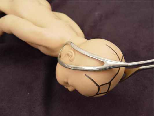 антенатальный дистресс плода