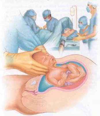 дистресс плода при родах