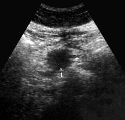 Эхограмма дивертикула двенадцатиперстной кишки, симулировавшего кисту поджелудочной железы