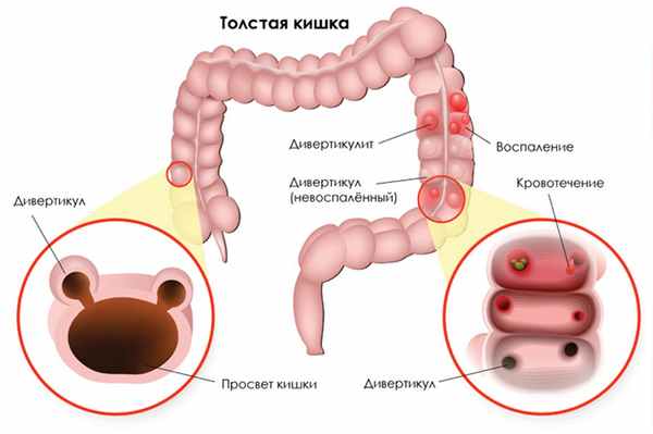 Дивертикулярная болезнь ободочной кишки. Простыми словами