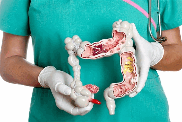 Дивертикулит