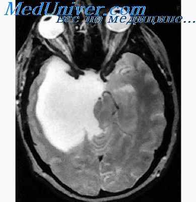 краниофарингиома