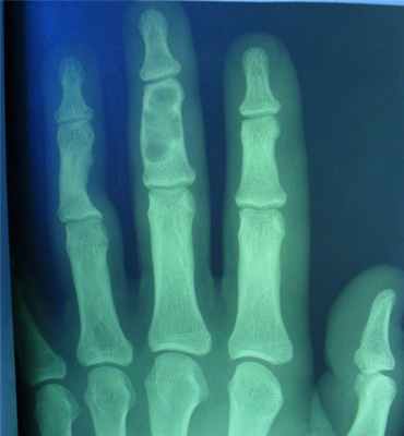 Новообразования костей5.jpg