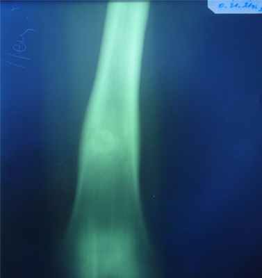 Новообразования костей3.jpg