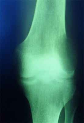 Новообразования костей7.jpg