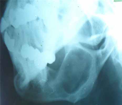 Новообразования костей13.jpg