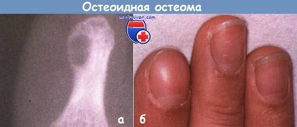 Остеоидная остеома