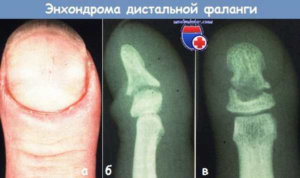 Энхондрома дистальной фаланги