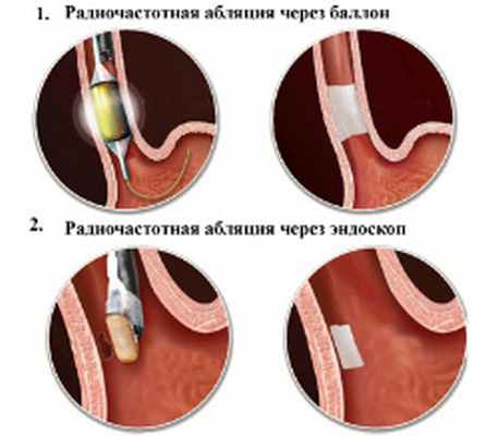 лечение опухоли пищевода