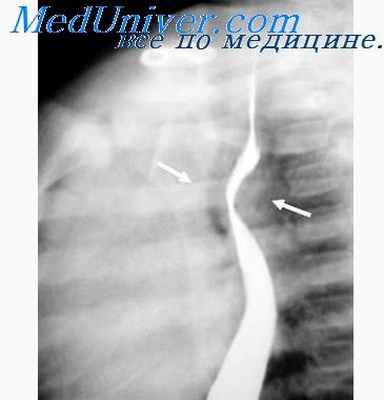 опухоли пищевода