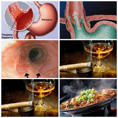 причины опухоли пищевода