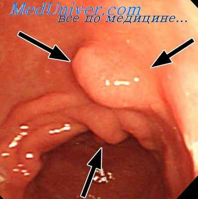 полипы желудка