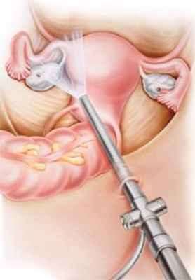 Доброкачественные опухоли яичников