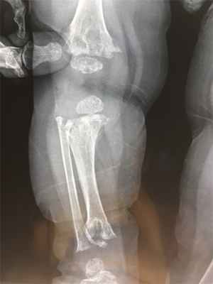 Метафизарная дисплазия