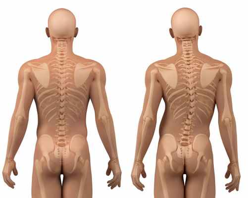 Сколиоз при метафизарной дисплазии