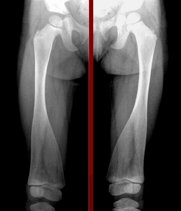 Болезнь Пайла