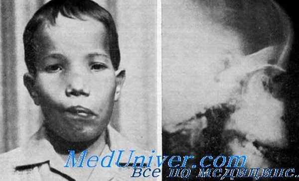 краниометафизарная дисплазия