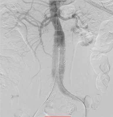 Имплантация стент-графта брюшной аорты