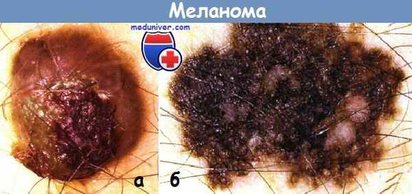 Меланома