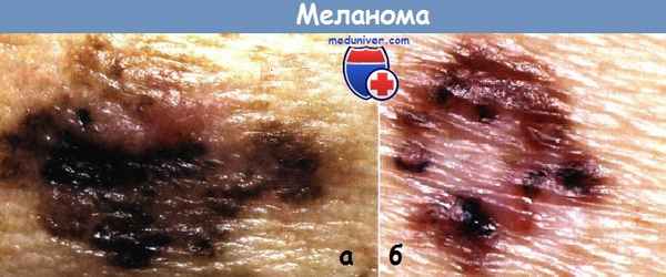 Меланома