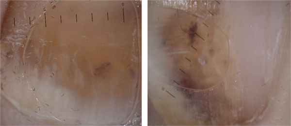 что будет если не лечить вросший ноготь