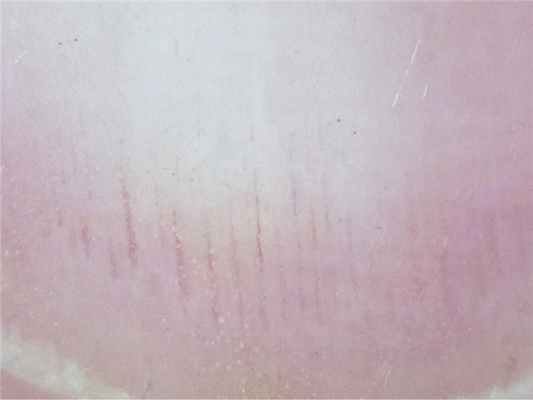 лечение вросшего ногтя без операции Подофикс