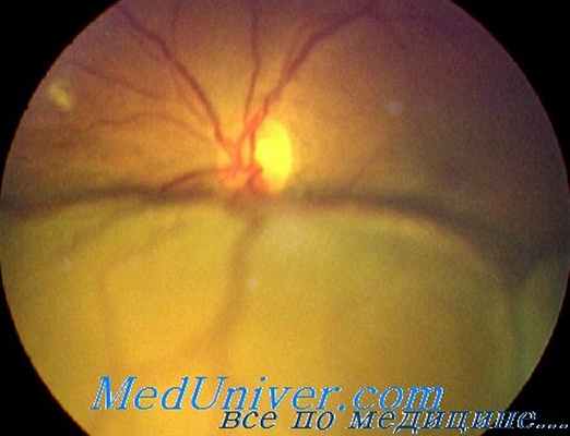 дренирование при отслойке сетчатки