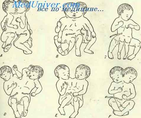 двойниковые уроды