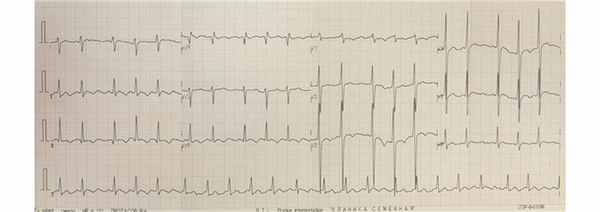 Ритм не синусовый, не правильный. Неправильная форма трепетания предсердий с частотой предсердной импульсации (волны F) 300 сокращений в минуту с кратностью проведением на желудочки 2:1 и 3:1. Типичное истмусзависимое. 