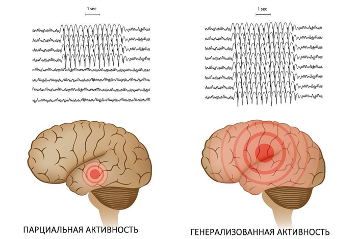 Расположение очагов активности на ЭЭГ