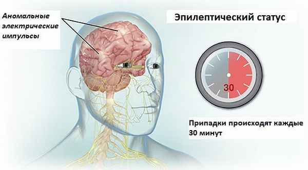 Частота припадков при эпилептическом статусе