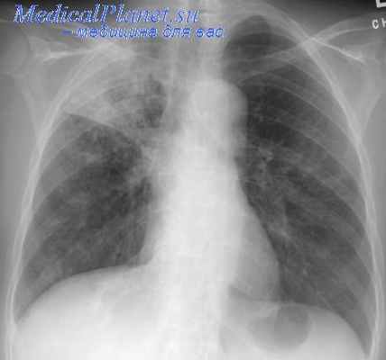 кавернотомия