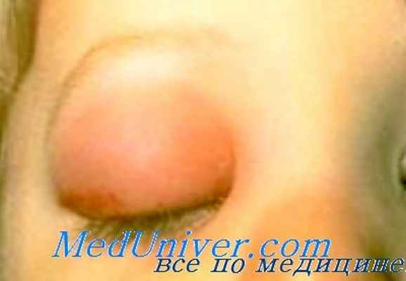 эффективность лечения эндофтальмита